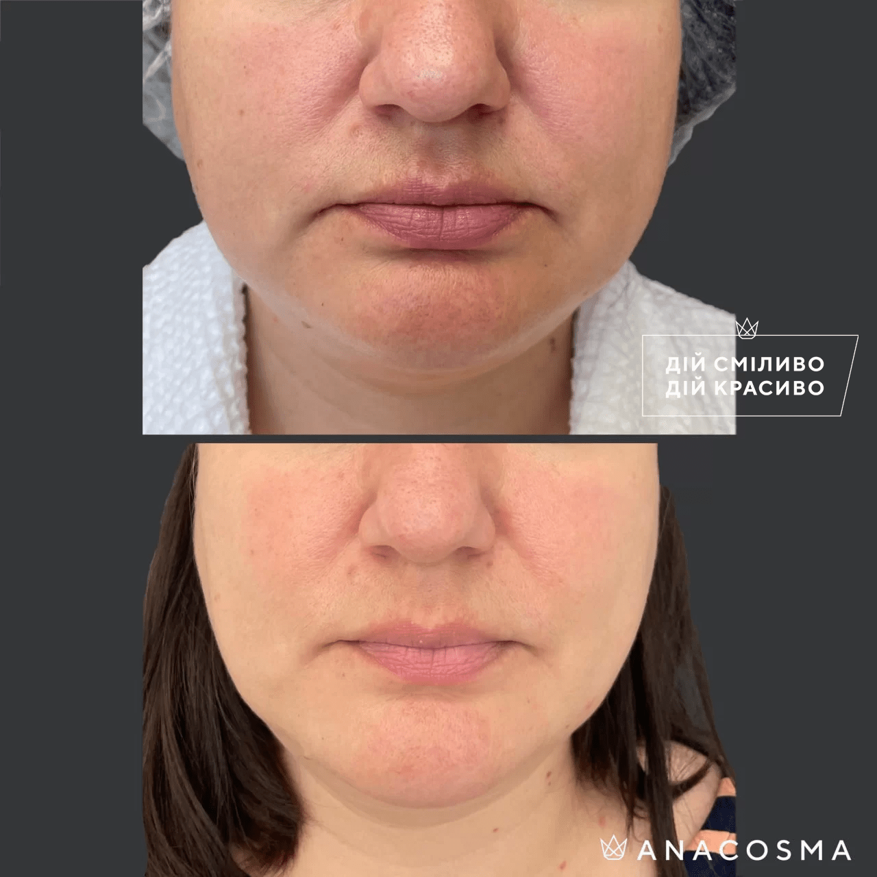 Ліполітики, Ферментотерапія до і після - Фото 3