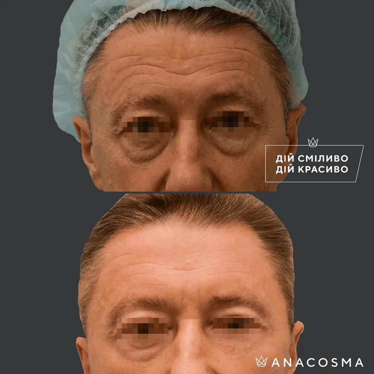 Підтяжка чола, ліфтинг брів до і після - Фото 4