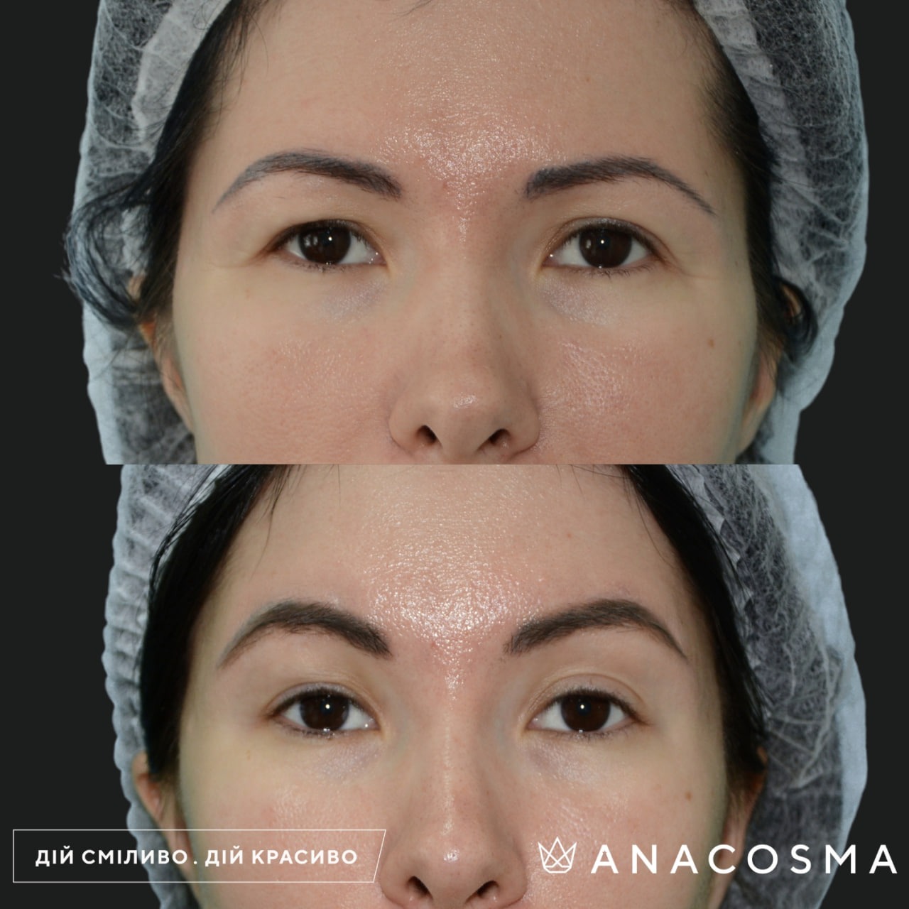 Підтяжка чола, ліфтинг брів до і після - Фото 6