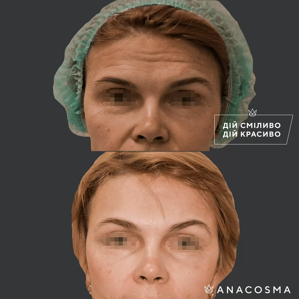 Підтяжка чола, ліфтинг брів до і після - Фото 3