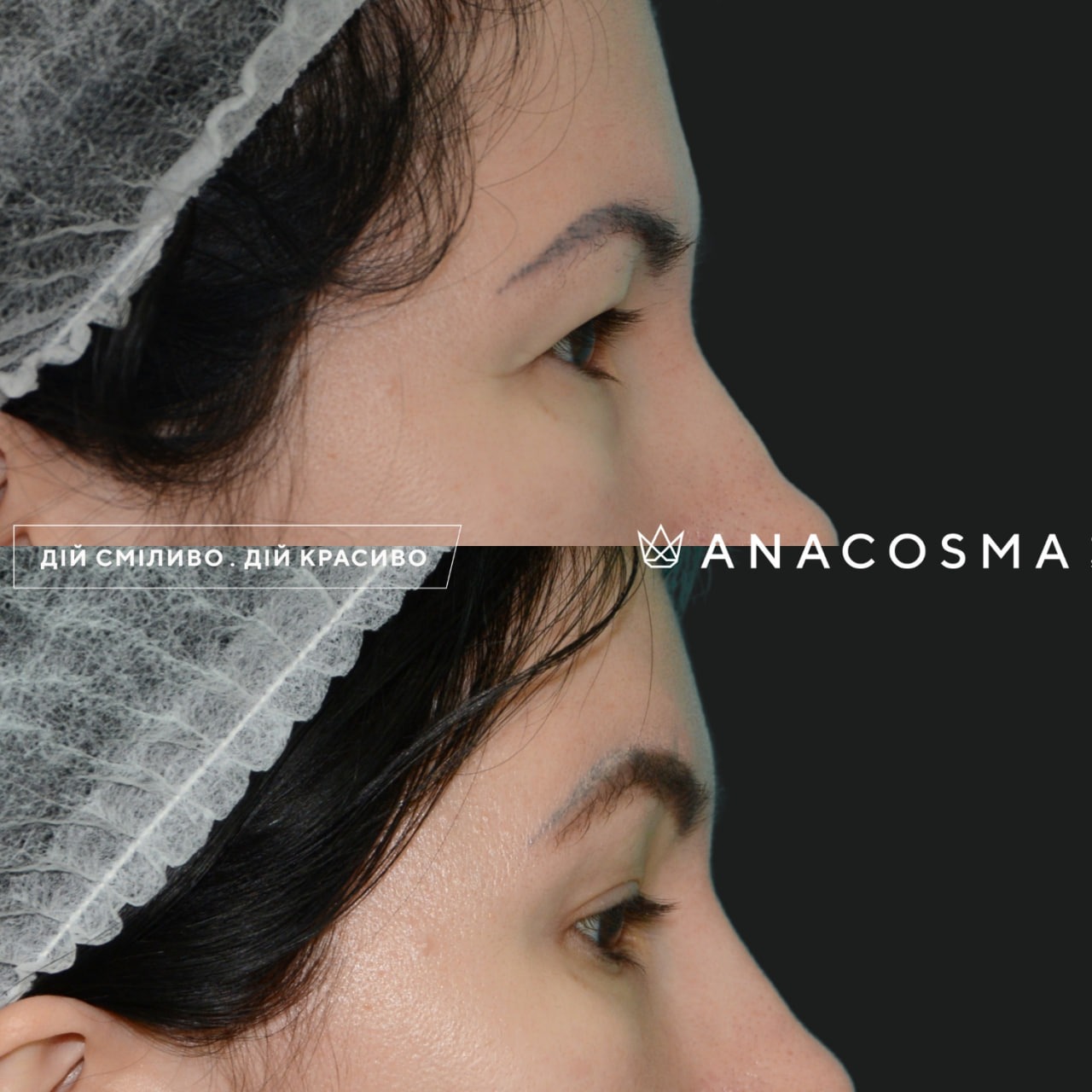 Підтяжка чола, ліфтинг брів до і після - Фото 7