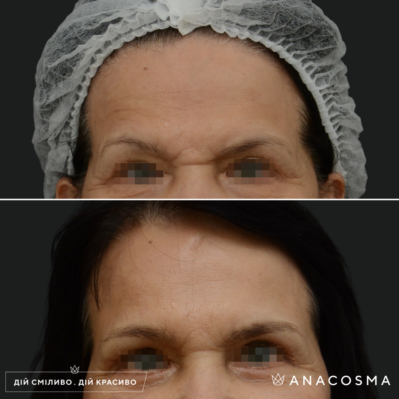 Підтяжка чола, ліфтинг брів до і після - Фото 8