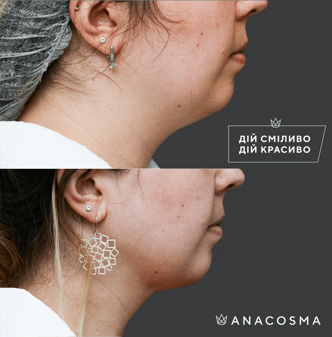 Ліпосакція обличчя до і після - Фото 6