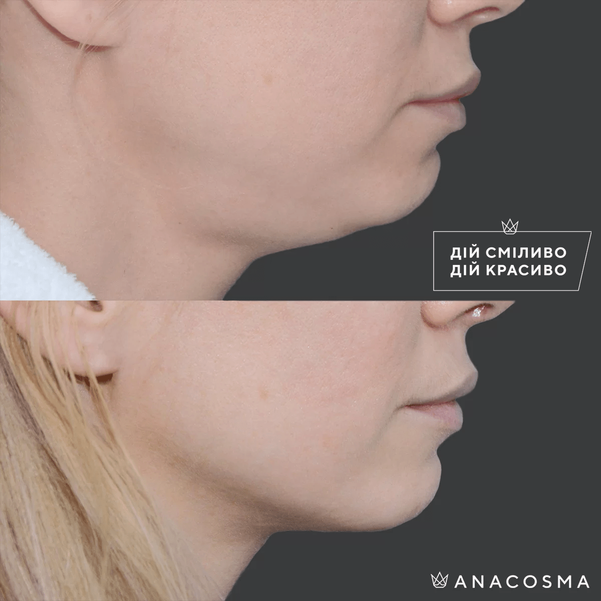 Ліпосакція обличчя до і після - Фото 7