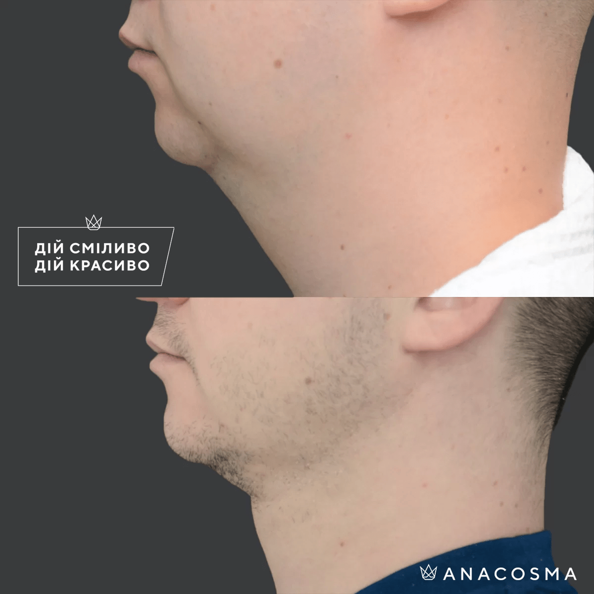 Ліпосакція обличчя до і після - Фото 8