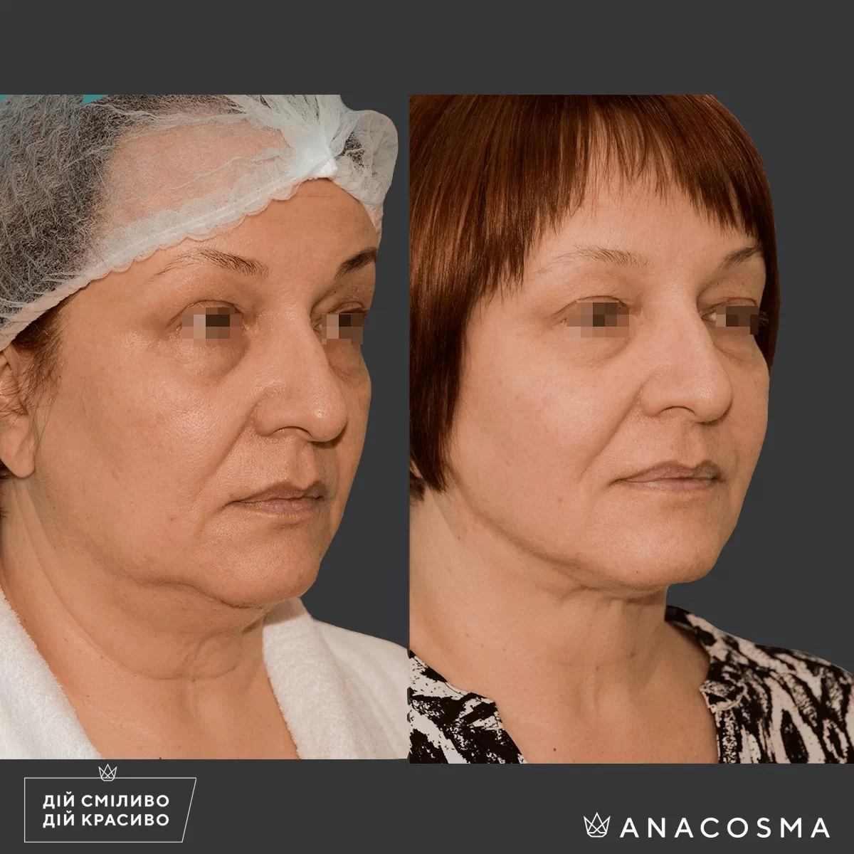 Ліпосакція обличчя до і після - Фото 2