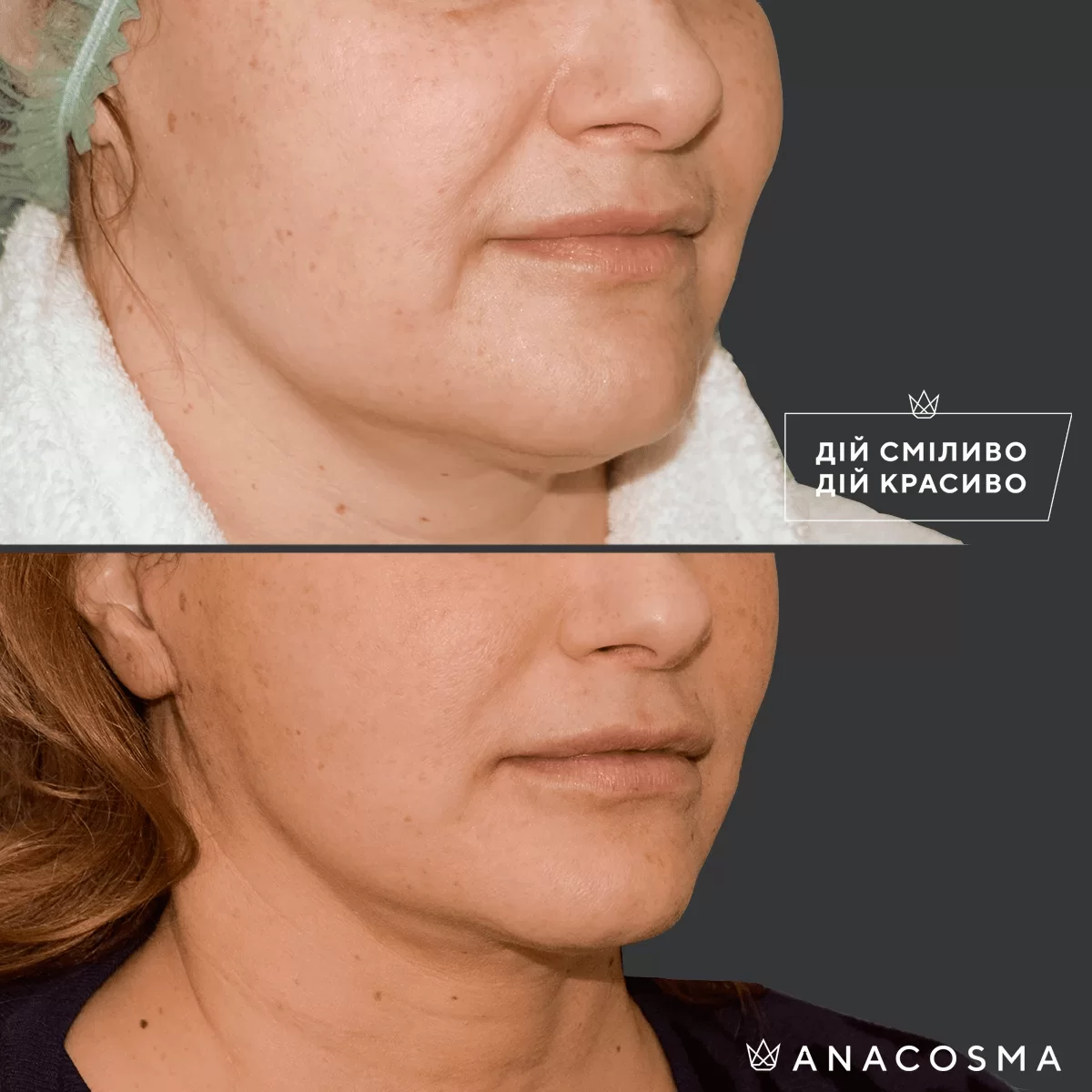 Ліпосакція обличчя до і після - Фото 3