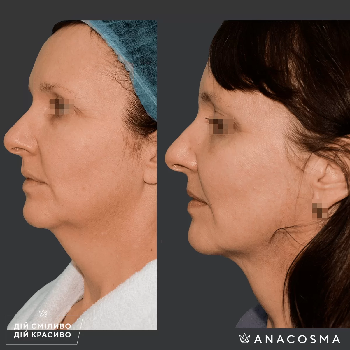 Ліпосакція обличчя до і після - Фото 4
