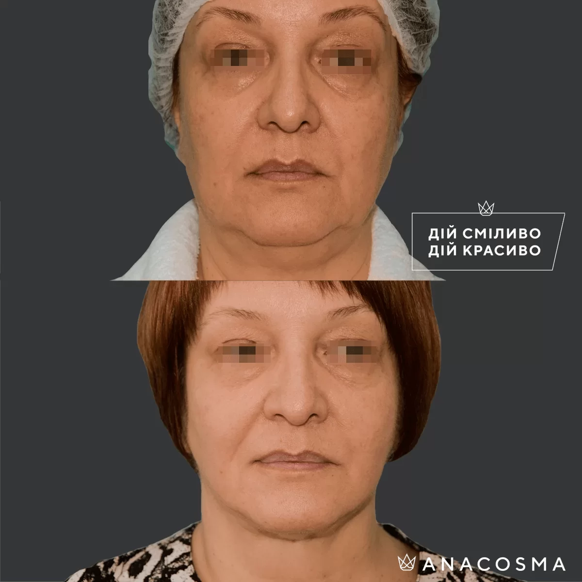 Ліпосакція обличчя до і після - Фото 5