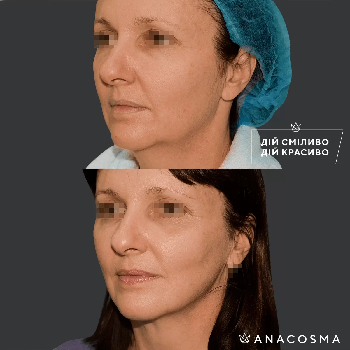 Ліпосакція обличчя до і після - Фото 12