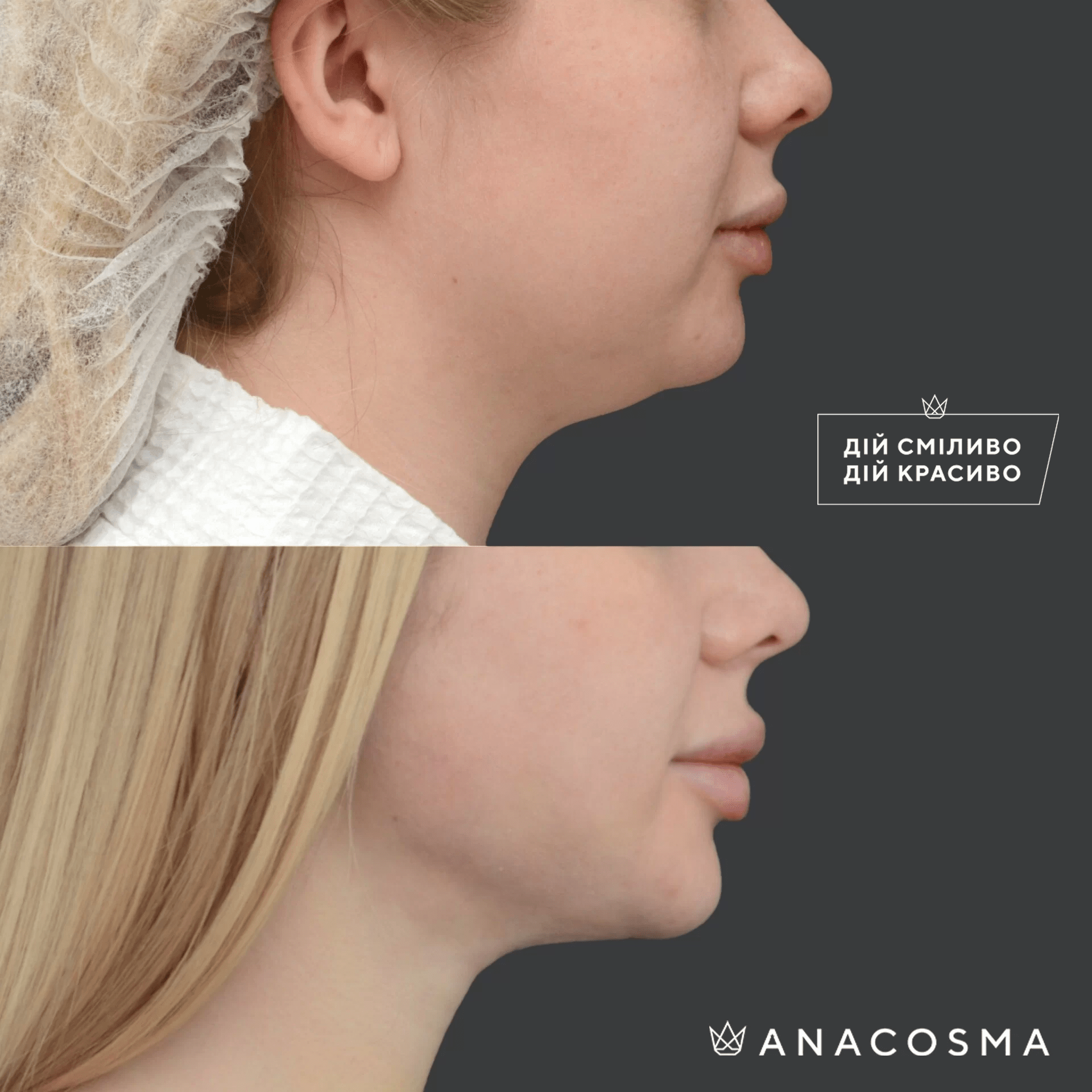 Ліпосакція обличчя до і після - Фото 9