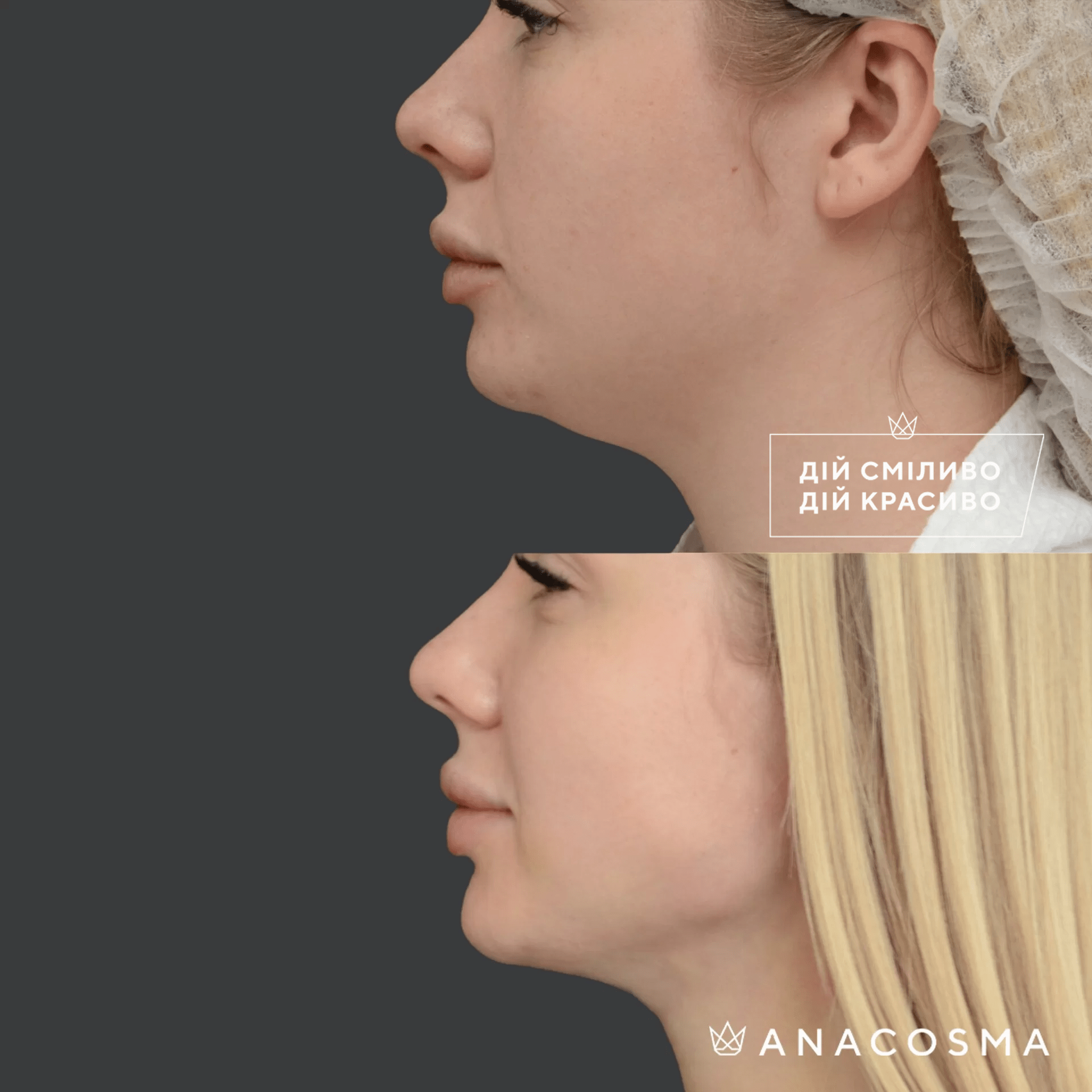 Ліпосакція обличчя до і після - Фото 10