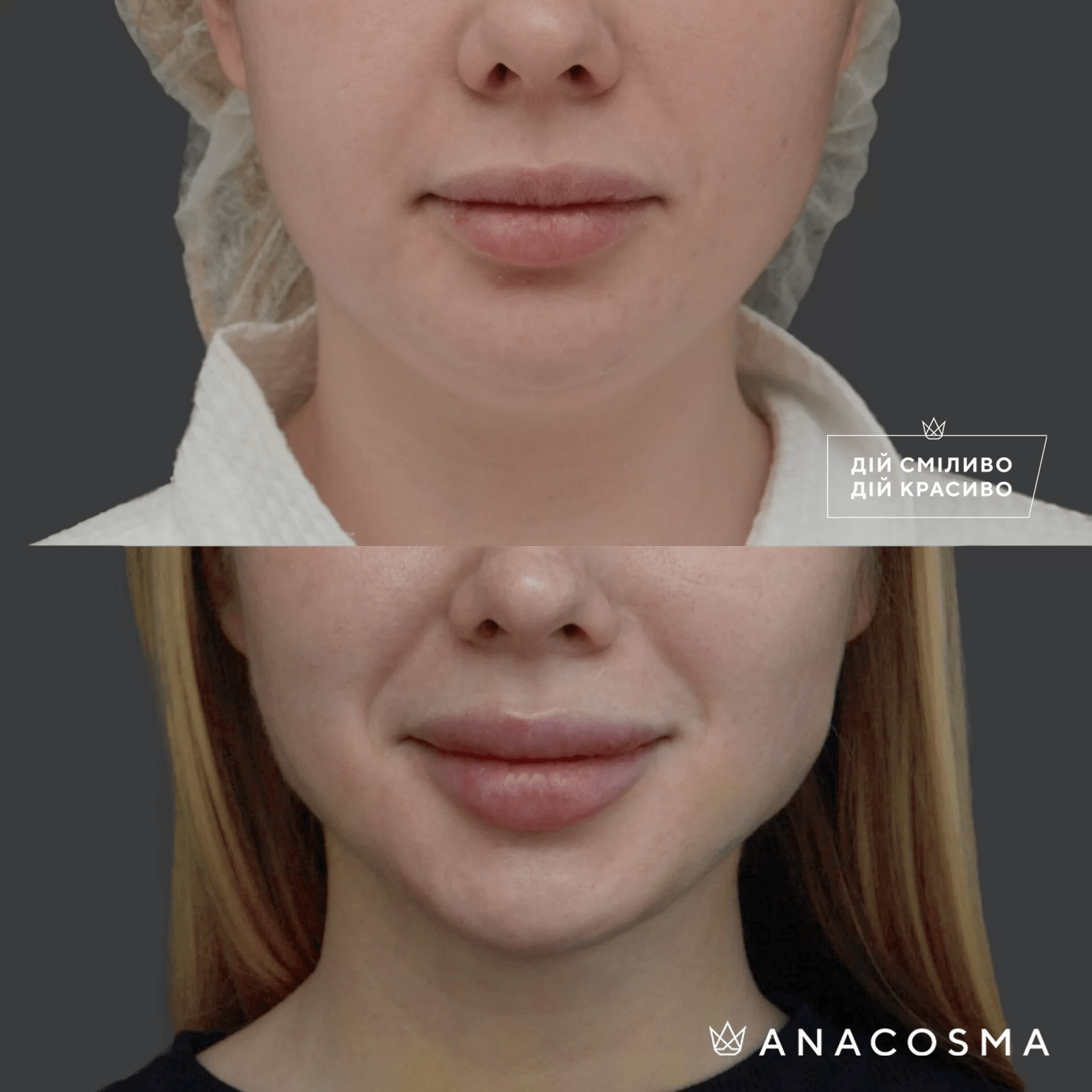 Ліпосакція обличчя до і після - Фото 11