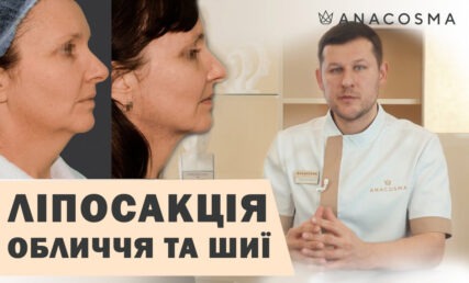 Ліпосакція обличчя, щік, другого підборіддя 🔥 КОЛИ МОЖНА, А КОЛИ - НІ❓ПРОКОЛИ☝🏻РЕАБІЛІТАЦІЯ