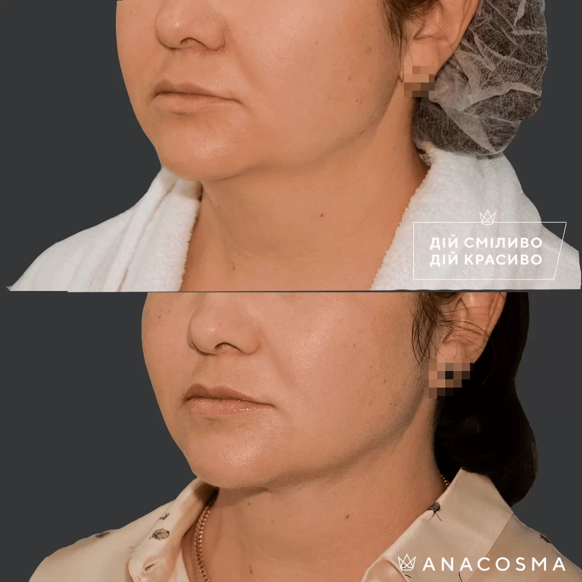 Ліпосакція обличчя до і після - Фото 1