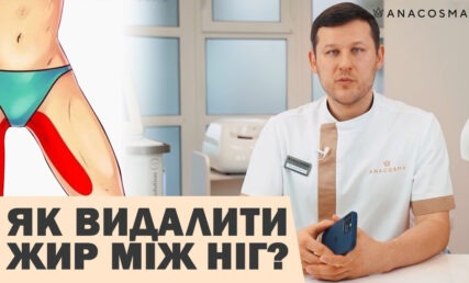 Ліпосакція внутрішньої сторони стегна: як забрати жир між ніг? 🔥