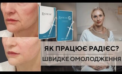 Що таке Радієс? Швидке омолодження обличчя #radiesse #радієсс #радіесс