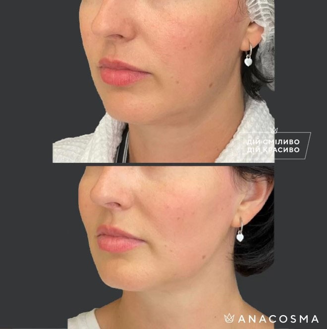 Волюмізація Радіес до і після - Фото 1