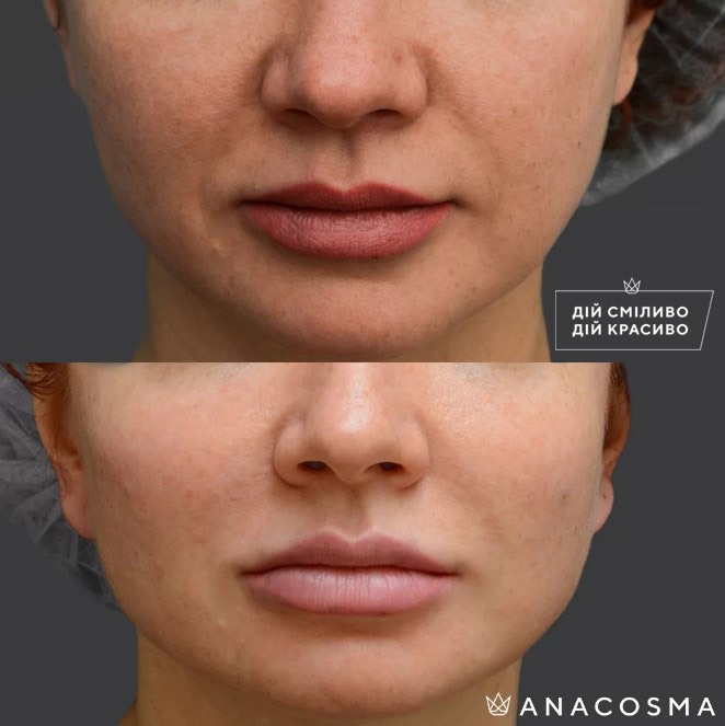 Волюмізація Радіес до і після - Фото 10