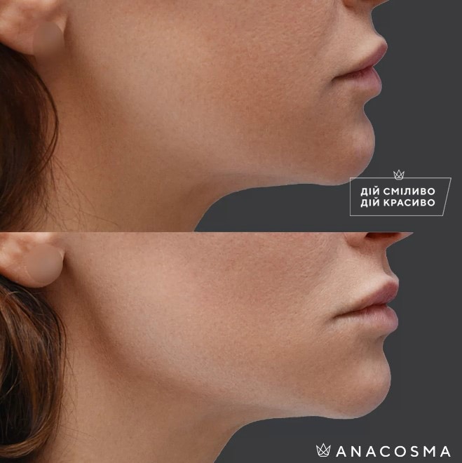 Волюмізація Радіес до і після - Фото 11