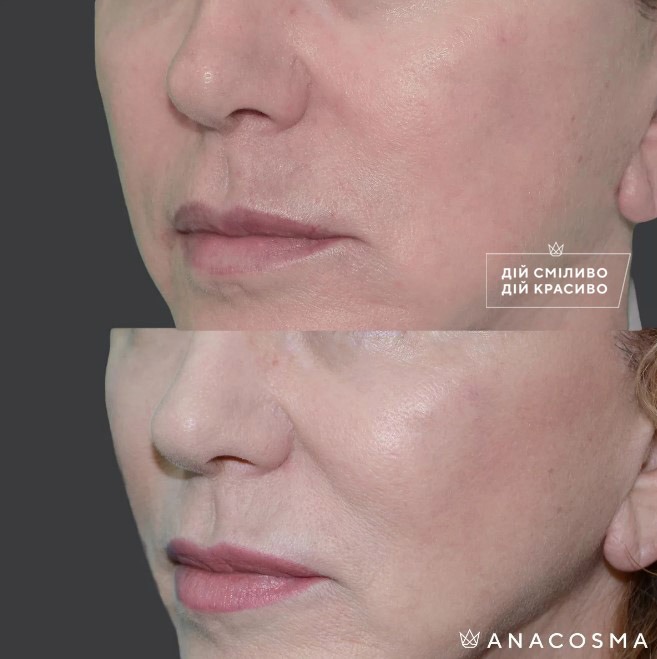 Волюмізація Радіес до і після - Фото 12