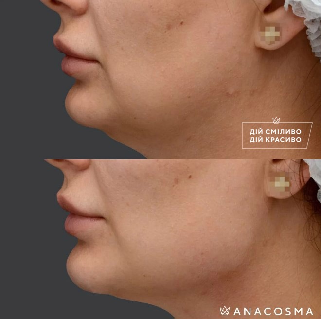 Волюмізація Радіес до і після - Фото 13