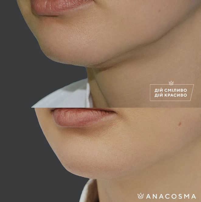 Волюмізація Радіес до і після - Фото 14