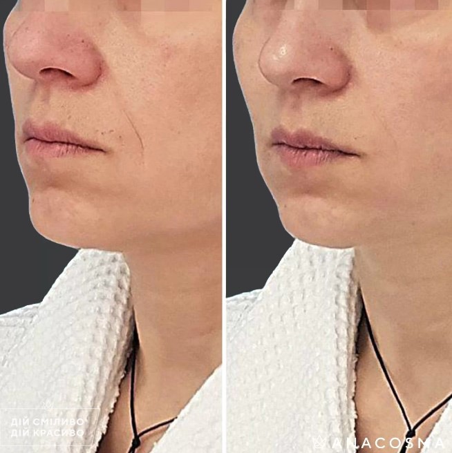 Волюмізація Радіес до і після - Фото 15