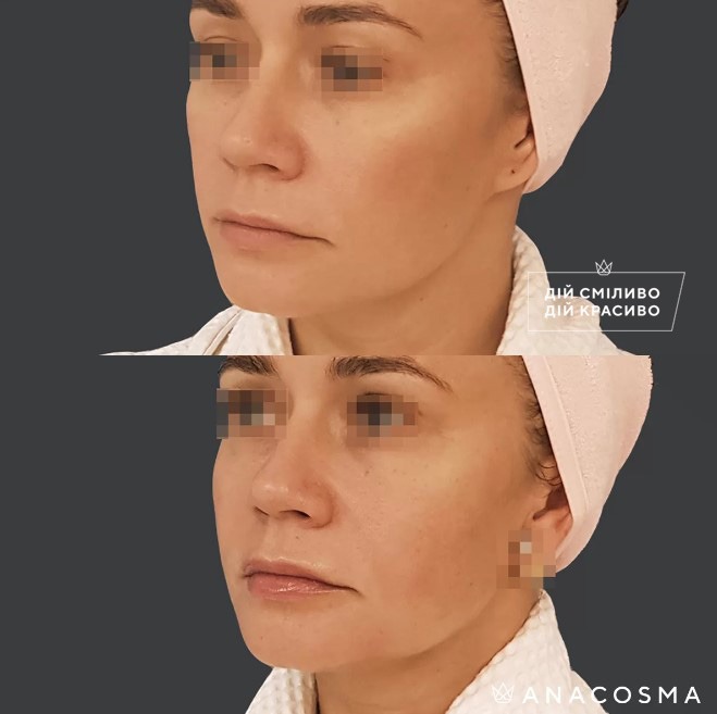 Волюмізація Радіес до і після - Фото 16