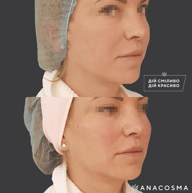 Волюмізація Радіес до і після - Фото 17