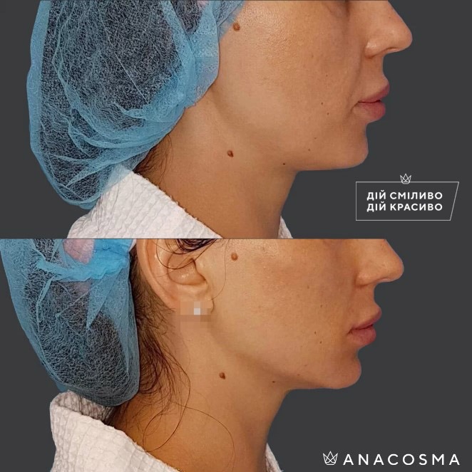 Волюмізація Радіес до і після - Фото 18