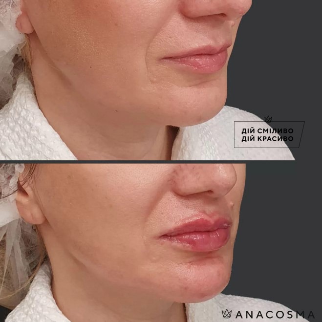 Волюмізація Радіес до і після - Фото 2