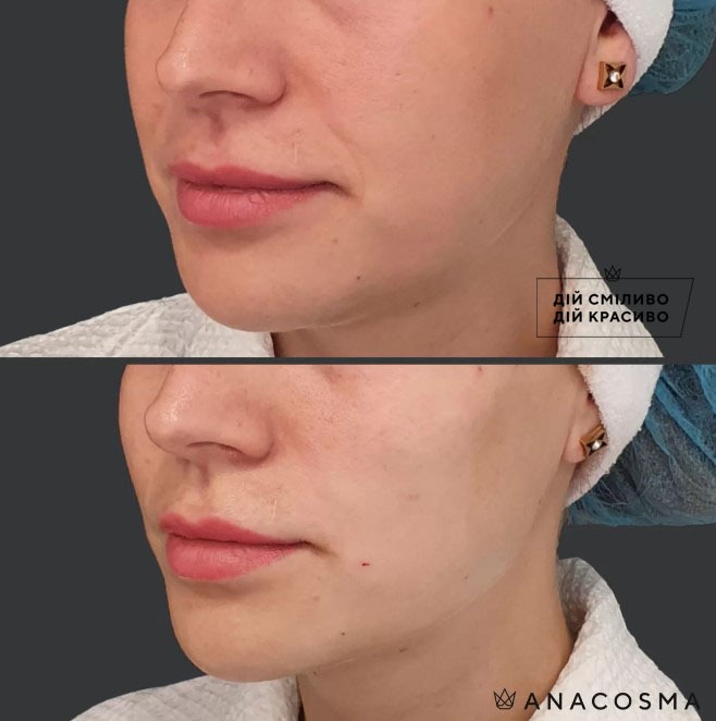 Волюмізація Радіес до і після - Фото 3