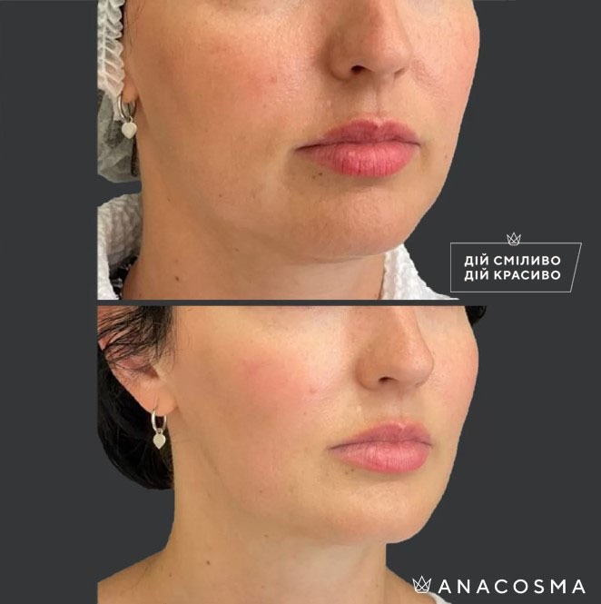 Волюмізація Радіес до і після - Фото 19