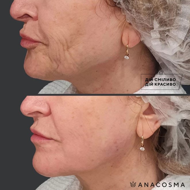 Волюмізація Радіес до і після - Фото 4