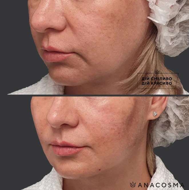 Волюмізація Радіес до і після - Фото 5