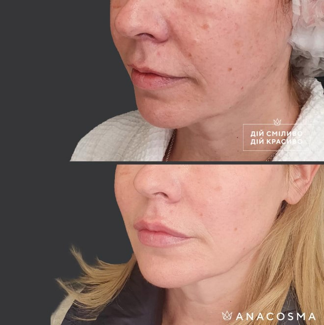 Волюмізація Радіес до і після - Фото 6