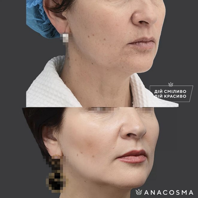 Волюмізація Радіес до і після - Фото 7