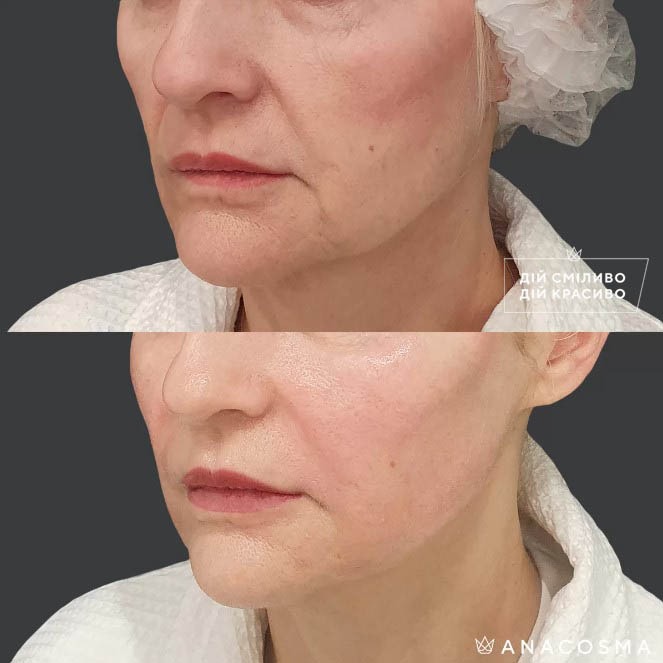 Волюмізація Радіес до і після - Фото 9