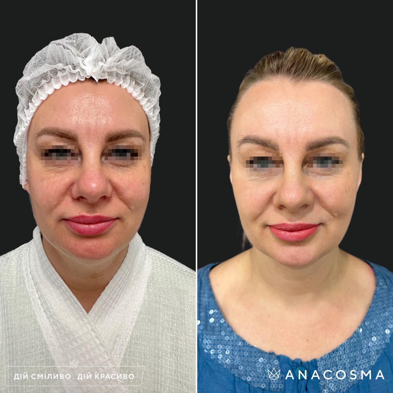 Волюмізація Радіес до і після - Фото 20