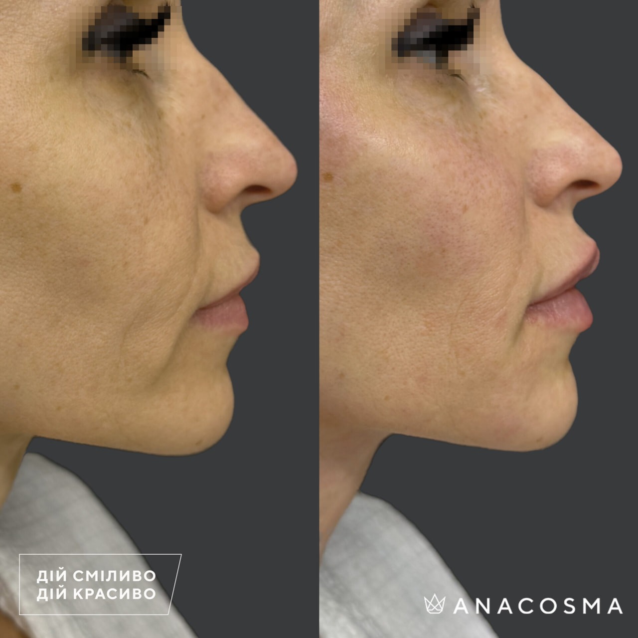 Волюмізація Радіес до і після - Фото 22