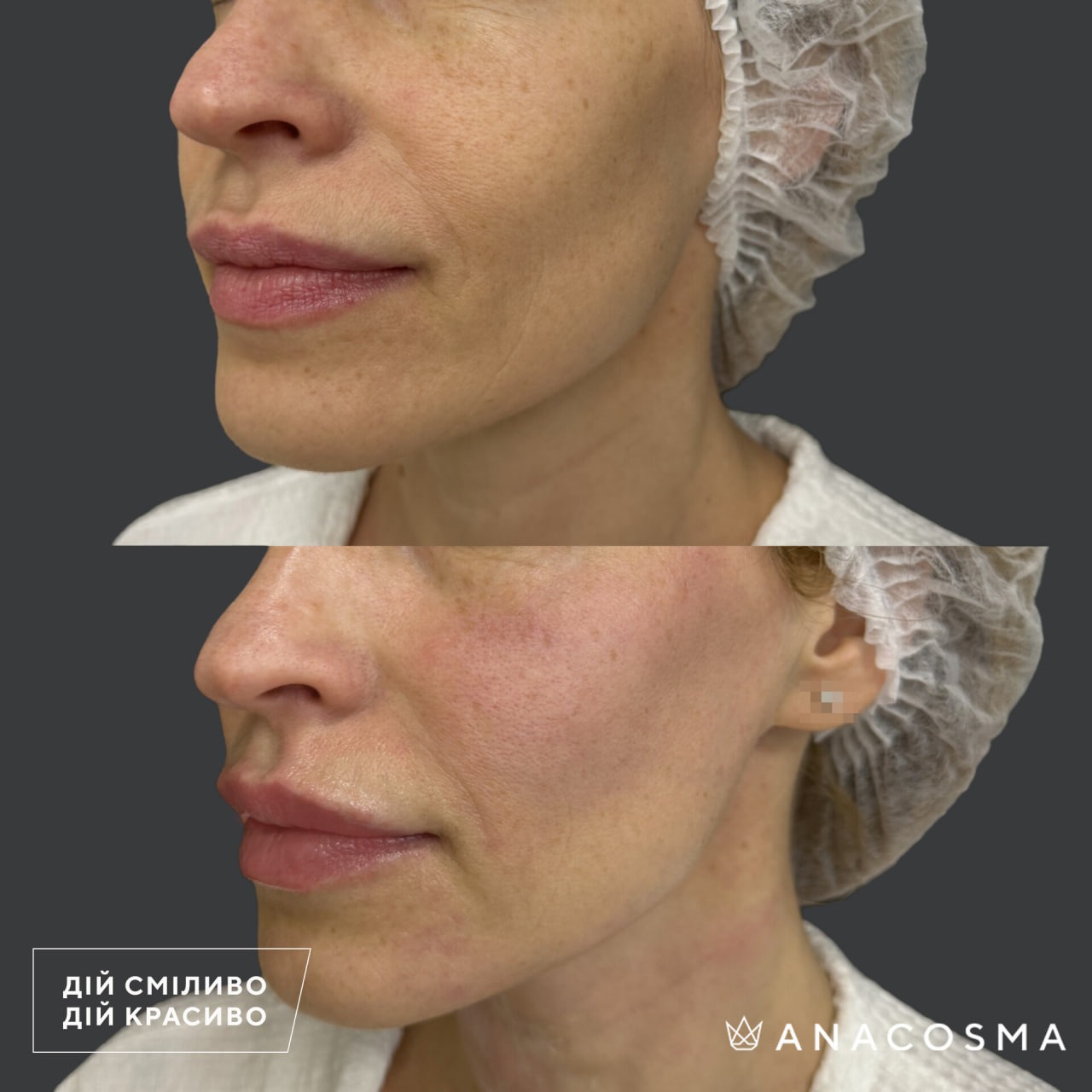 Волюмізація Радіес до і після - Фото 23