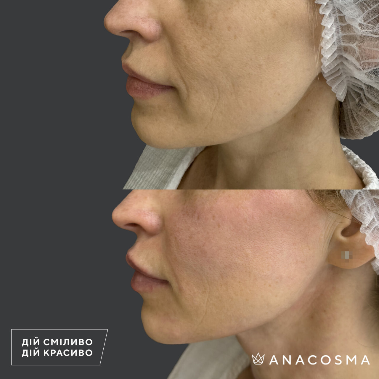 Волюмізація Радіес до і після - Фото 24