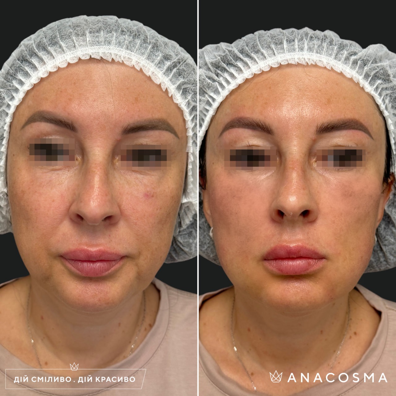 Волюмізація Радіес до і після - Фото 25