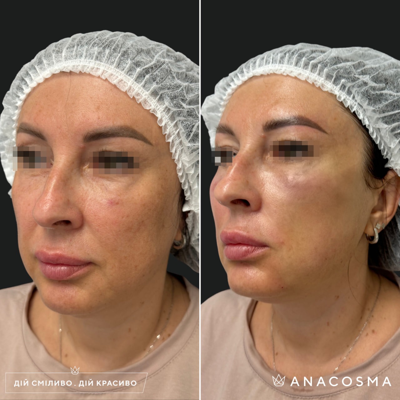 Волюмізація Радіес до і після - Фото 26