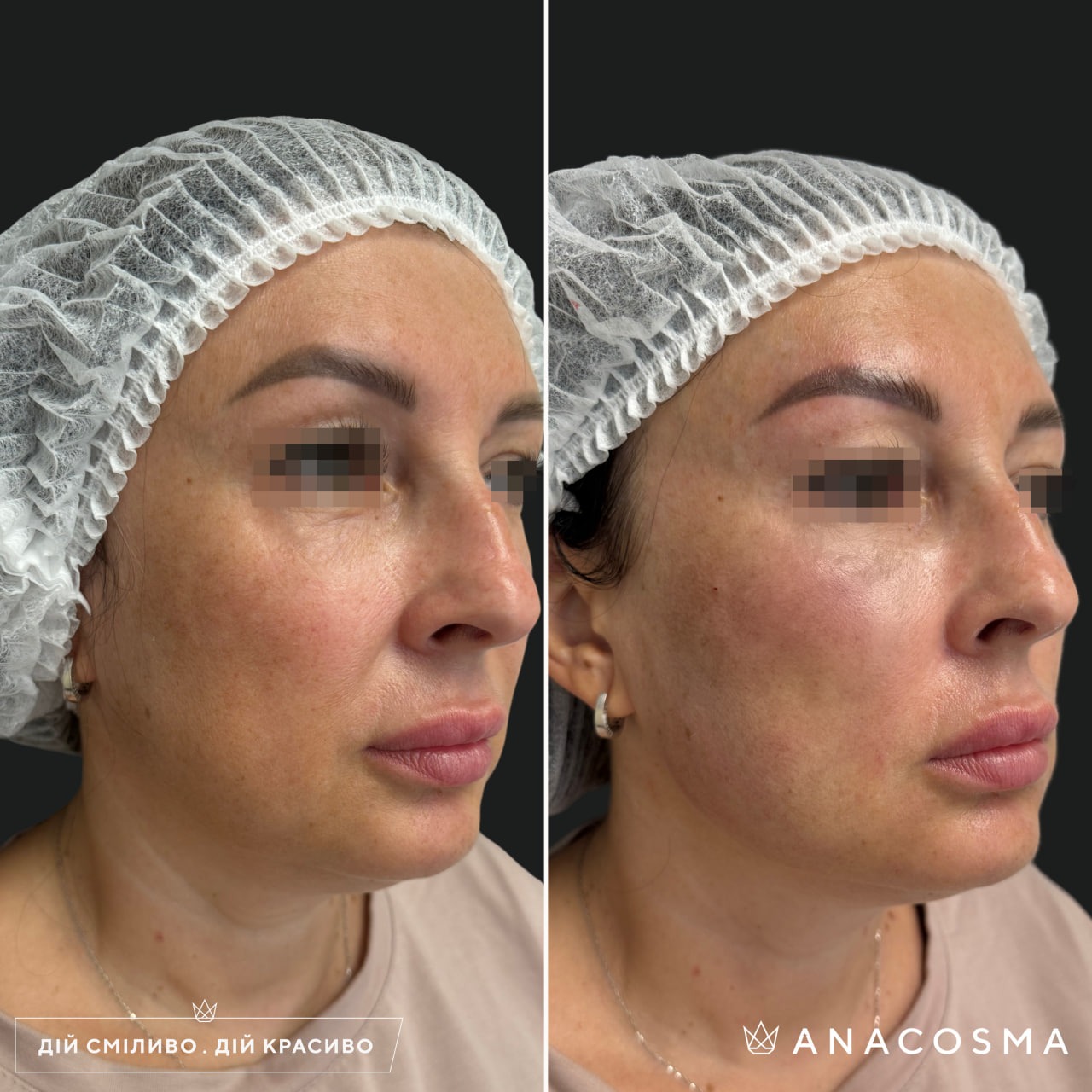 Волюмізація Радіес до і після - Фото 27