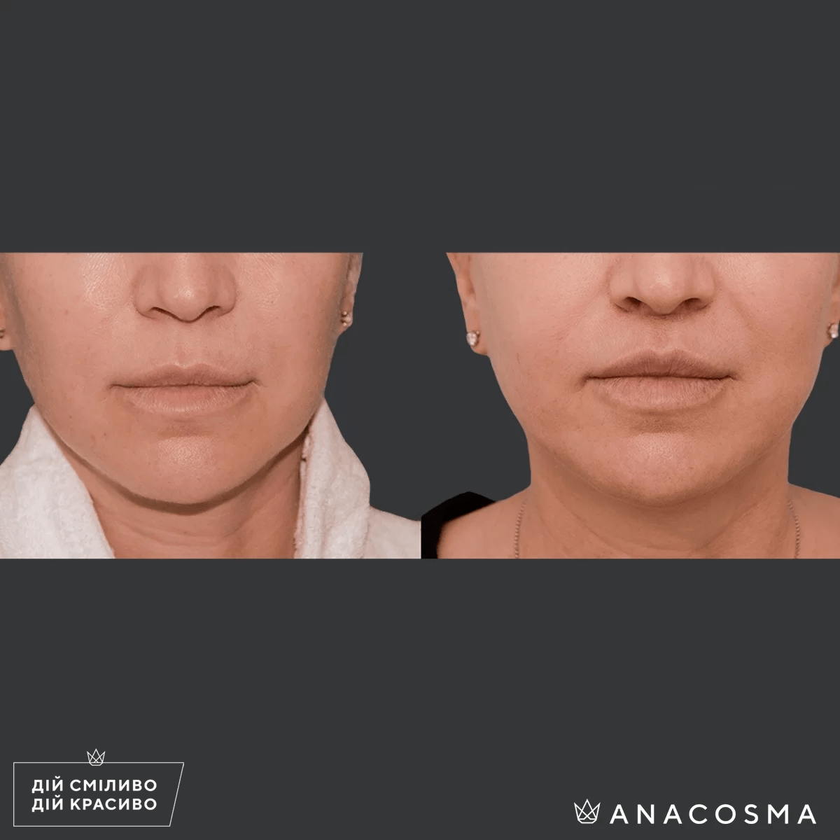 Булхорн (Хейлопластика) до і після - Фото 1