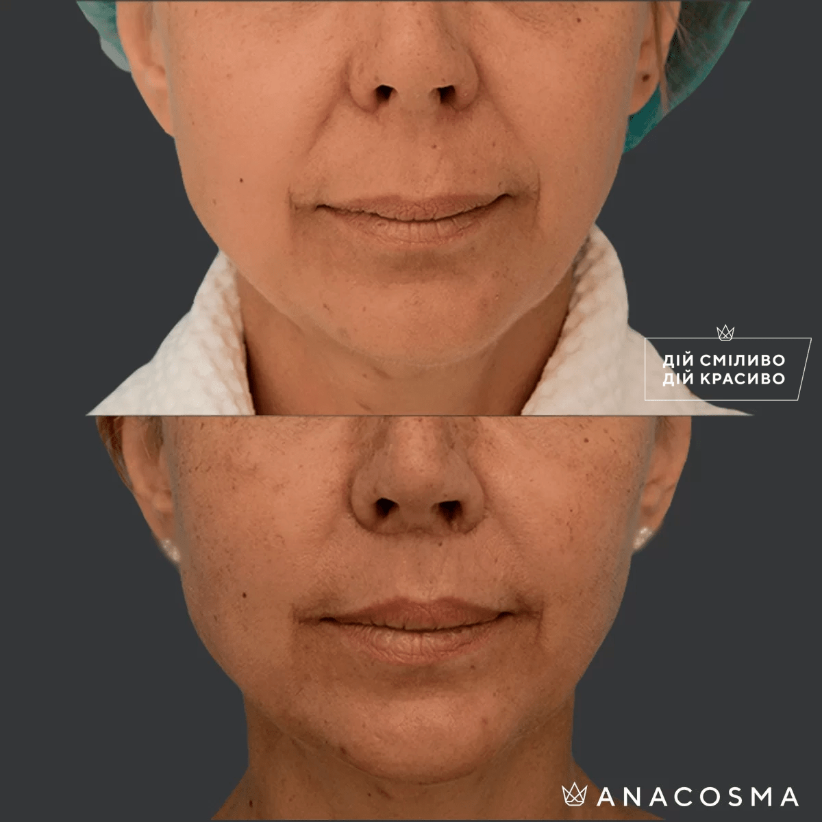 Булхорн (Хейлопластика) до і після - Фото 2