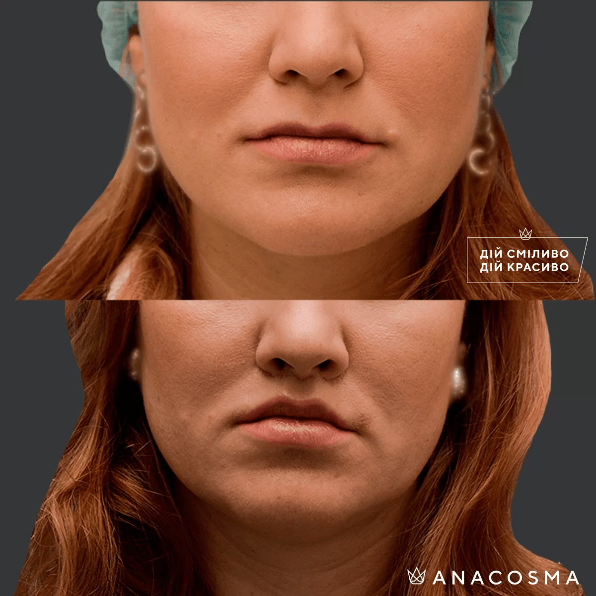 Булхорн (Хейлопластика) до і після - Фото 3