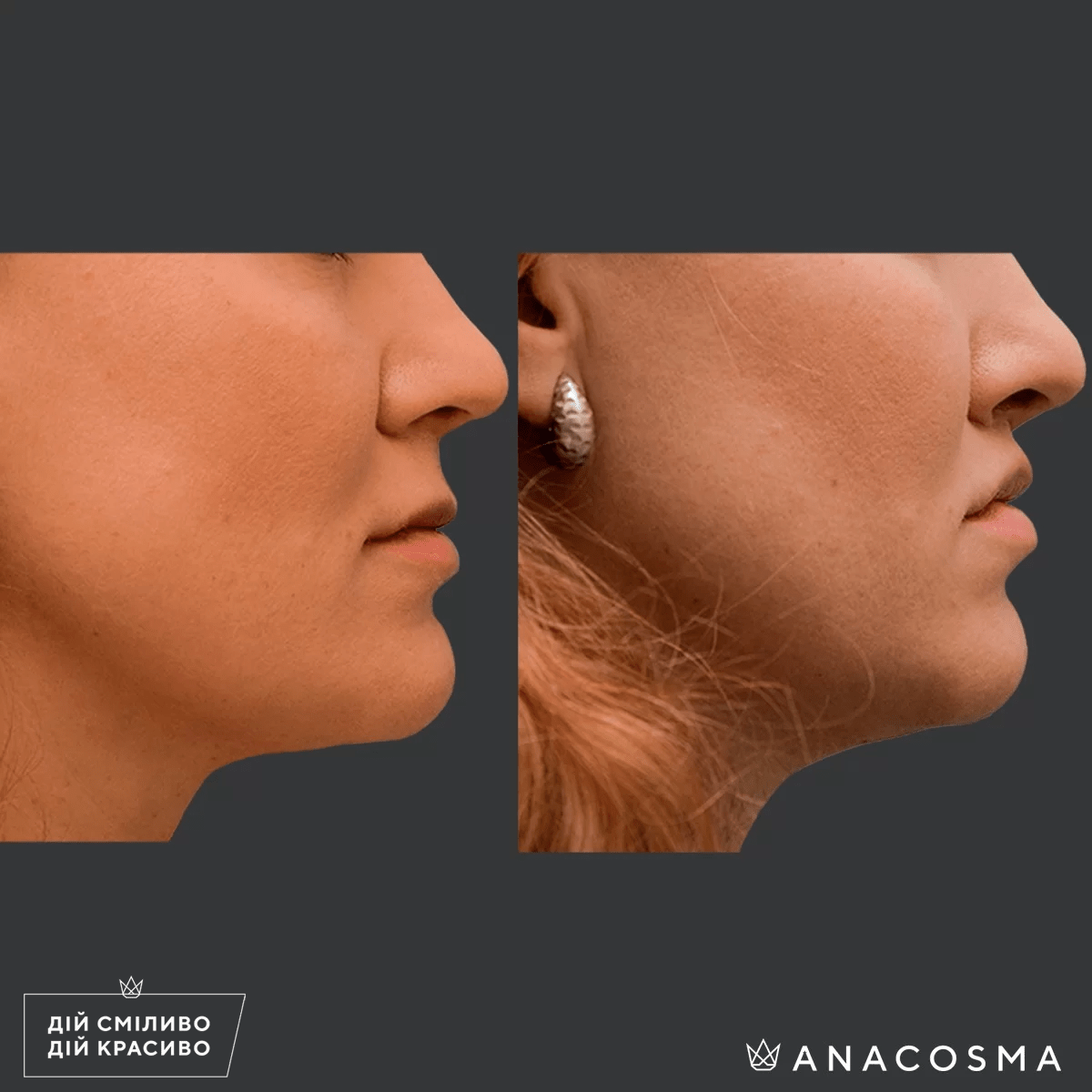 Булхорн (Хейлопластика) до і після - Фото 4